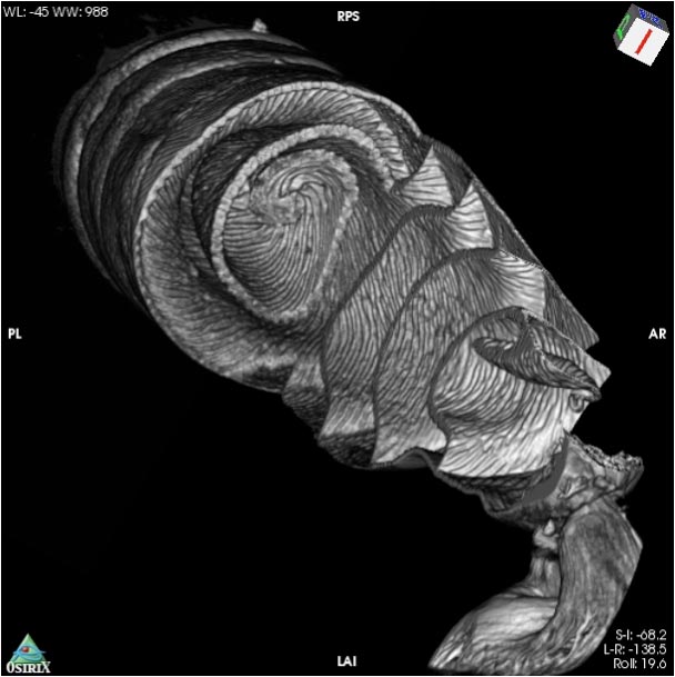 CT 扫描角鲨螺旋肠
